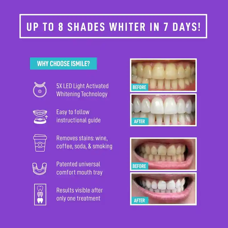 35% Carbamide Peroxide Whitening Kit (4)