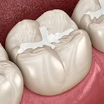 Anti-Cavity