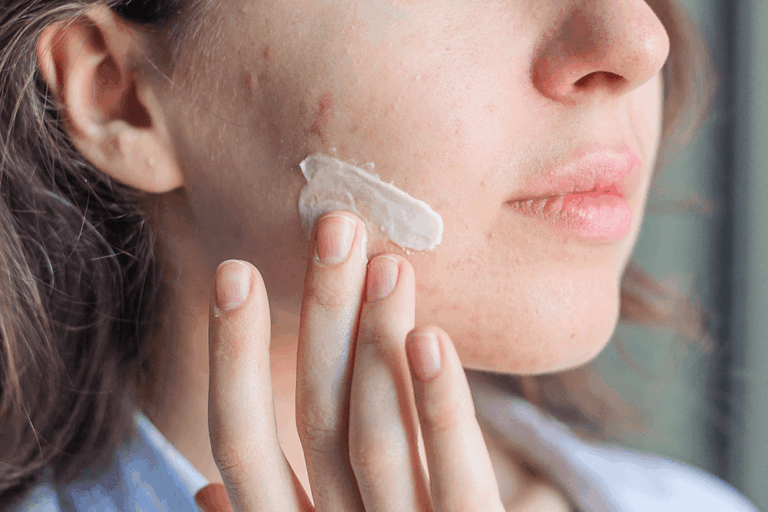 Can Toothpaste Remove Pimples Dermatologists Weigh In