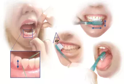 Meningkatkan kesehatan mulut dengan cepillado dan penggunaan hilo dental