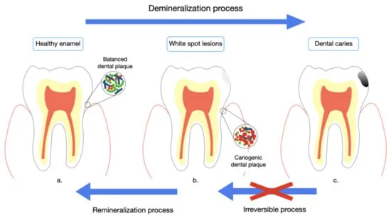 Composición y principio del polvo dental remineralizante