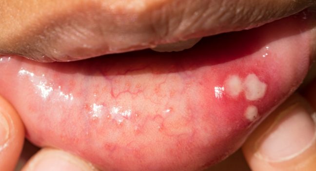Identify Canker Sore