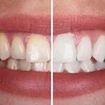 Mild Whitening