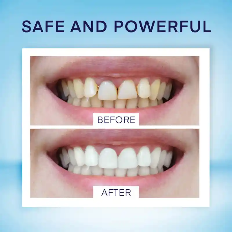 No Sensitivity Teeth Whitening Pen (5)