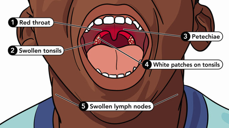 Strep Throat