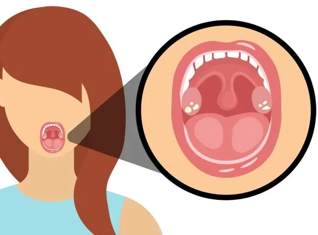 Batu Tonsil