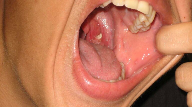 What Are Tonsil Stones
