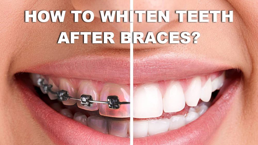 Whitening Toothpaste with Braces