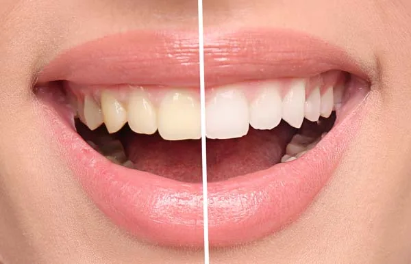 branqueamento dos dentes-Lidercare