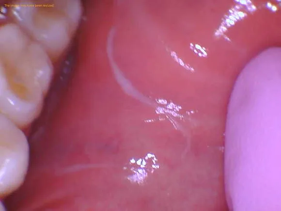 white stringy stuff on side of cheek